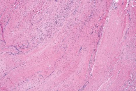 Fig. 35.128, Palmar fibromatosis: older lesions are characteristically hypocellular and consist largely of broad bundles of hyalinized collagen.