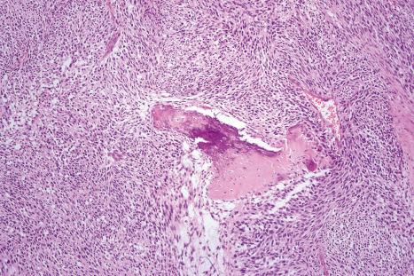 Fig. 35.129, Plantar fibromatosis: this example is strikingly cellular and shows focal osseous metaplasia.