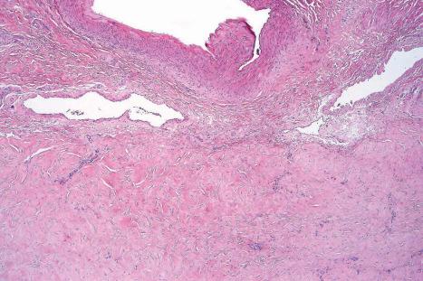 Fig. 35.130, Penile fibromatosis: biopsy from end-stage disease showing dense collagen without any significant inflammation. Despite its name, the condition most probably represents a reactive process.