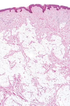 Fig. 35.13, Nevus lipomatosus superficialis: this specimen came from the lower back of a teenage male. There is widespread infiltration of the dermis by mature adipocytes.