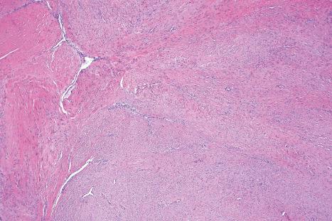 Fig. 35.131, Desmoid fibromatosis: low-power view showing cellular bundles with focal collagen deposition.