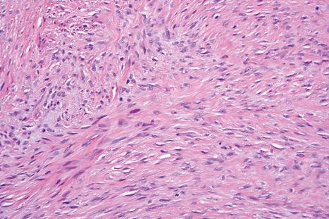 Fig. 35.132, Desmoid fibromatosis: the tumor is composed of spindled cells with a variable admixture of collagen.