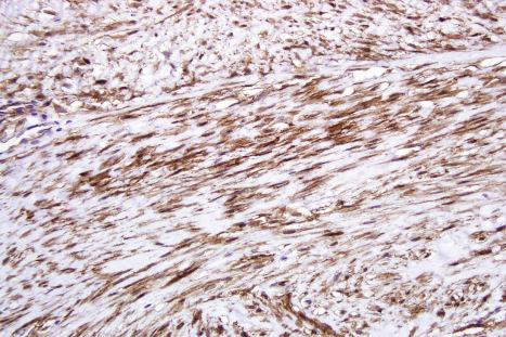 Fig. 35.134, Desmoid fibromatosis: the spindled cells are beta-catenin positive.