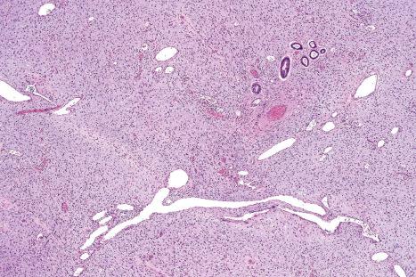 Fig. 35.135, Giant cell fibroblastoma: the admixture of dilated vessel-like spaces and mixed spindled and giant cells in a myxoid stroma is characteristic.