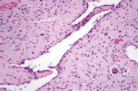 Fig. 35.136, Giant cell fibroblastoma: medium-power view showing blood-vessel–like space lined by tumor cells.