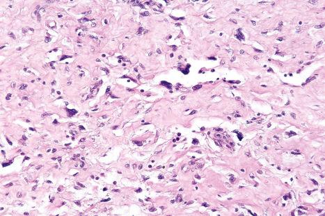 Fig. 35.137, Giant cell fibroblastoma: the sinusoid-like spaces are lined by multinucleate giant cells.