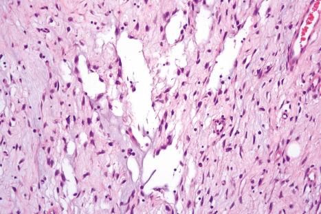 Fig. 35.139, Giant cell fibroblastoma: higher-power view of the left side of the field showing typical features.