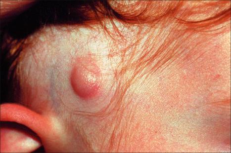 Fig. 35.140, Dermatofibrosarcoma protuberans: congenital lesions as shown here are exceedingly rare.