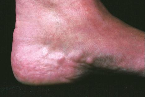 Fig. 35.14, Piezogenic pedal papules: note the multiple flesh-colored papules on the heel and lateral border of the foot.