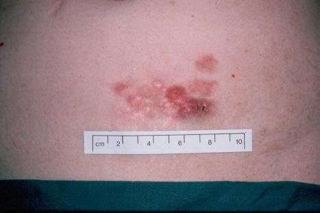 Fig. 35.141, Dermatofibrosarcoma protuberans: a typical multinodular reddish-blue plaque is present on the lower abdomen of a middle-aged female.