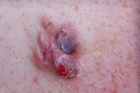 Fig. 35.142, Dermatofibrosarcoma protuberans: close-up view.