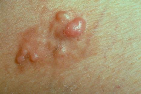 Fig. 35.143, Dermatofibrosarcoma protuberans: this example shows a combination of a plaque and nodules.