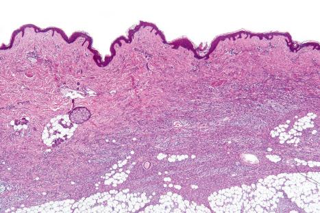 Fig. 35.145, Dermatofibrosarcoma protuberans: the lower dermis is replaced by a dense cellular infiltrate. In contrast to fibrous histiocytoma, the epidermis appears normal.