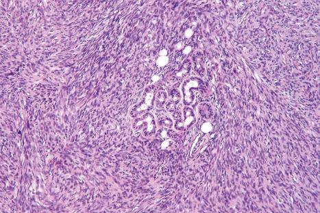 Fig. 35.149, Dermatofibrosarcoma protuberans: adnexal sparing is typically seen.