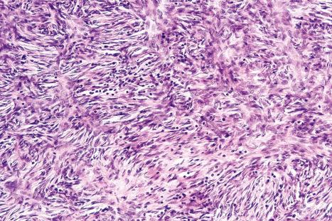 Fig. 35.150, Dermatofibrosarcoma protuberans: a diffuse lymphocytic infiltrate is present in this field.