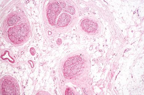 Fig. 35.15, Lipomatosis of nerve: note the extensive epineural fat deposition.