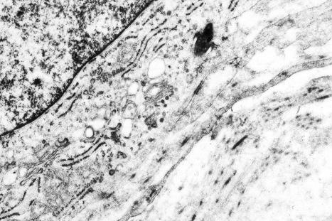 Fig. 35.153, Dermatofibrosarcoma protuberans: myofibroblastic differentiation is not a feature of this tumor.