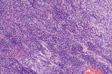 Fig. 35.154, Dermatofibrosarcoma protuberans: this is an example of fibrosarcomatous change. Note the characteristic herringbone pattern.