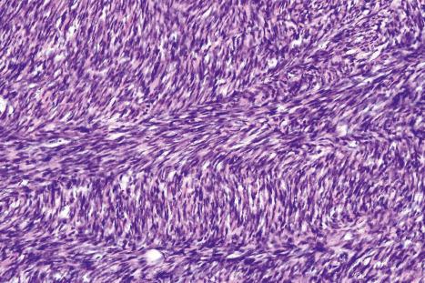 Fig. 35.155, Dermatofibrosarcoma protuberans: high-power view.