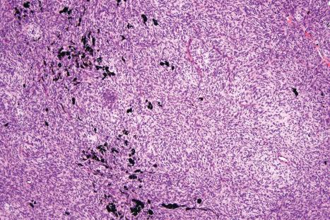 Fig. 35.156, Bednár tumor: except for the foci of pigmented cells, the appearances are identical to those of dermatofibrosarcoma protuberans.