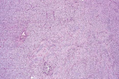 Fig. 35.158, Myxoid dermatofibrosarcoma protuberans: myxoid areas, as seen here, are nondiagnostic and therefore may cause confusion. A careful search should be made for more typical foci.