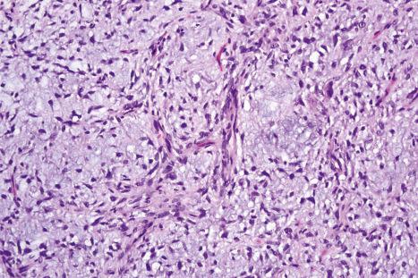 Fig. 35.159, Myxoid dermatofibrosarcoma protuberans: high-power view.