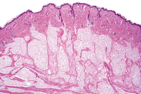 Fig. 35.16, Lipoblastoma: at low power, the tumor is lobulated and composed of mature fat cells and numerous multivacuolated lipoblasts.