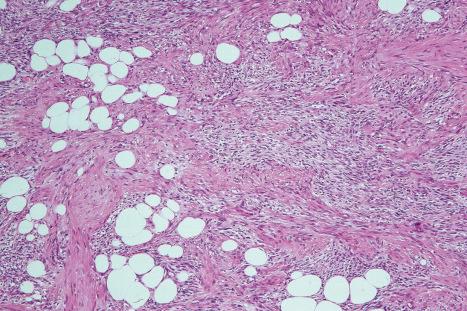 Fig. 35.161, Dermatofibrosarcoma protuberans: some tumors, particularly the fibrosarcomatous variant, contain nodules and bundles of myofibroblasts (the myoid variant).