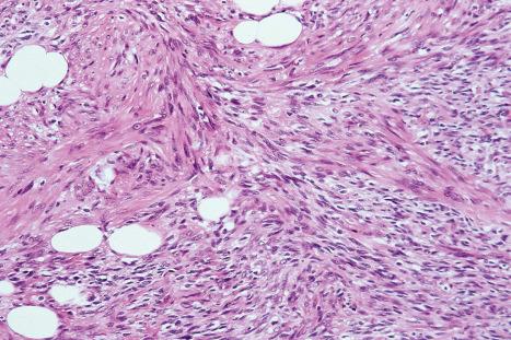 Fig. 35.162, Dermatofibrosarcoma protuberans: high-power view of Figure 35.170 .