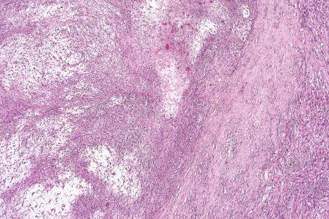 Fig. 35.163, Acral myxoinflammatory fibroblastic sarcoma: within the dermis is a multinodular tumor with striking myxoid change.