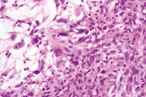 Fig. 35.164, Acral myxoinflammatory fibroblastic sarcoma: this lesion consists of stellate and histiocyte-like cells with scattered mononuclear inflammatory cells dispersed within the myxoid stroma.
