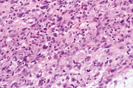 Fig. 35.165, Acral myxoinflammatory fibroblastic sarcoma: high-power view showing tumor cells with admixed lymphocytes and conspicuous eosinophils.