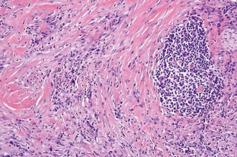 Fig. 35.167, Inflammatory myofibroblastic tumor: medium-power view with conspicuous myofibroblasts.