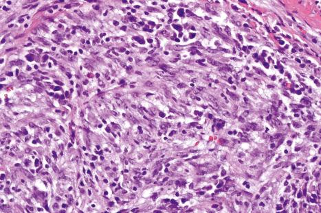 Fig. 35.168, Inflammatory myofibroblastic tumor: the tumor cells are admixed with lymphocytes, eosinophils, and plasma cells.