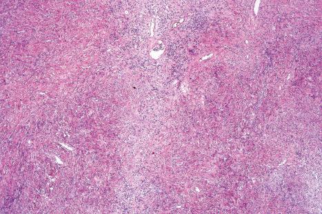 Fig. 35.169, Solitary fibrous tumor: low-power view of a spindle cell tumor with focal hyalinization. Note the prominent blood vessels.