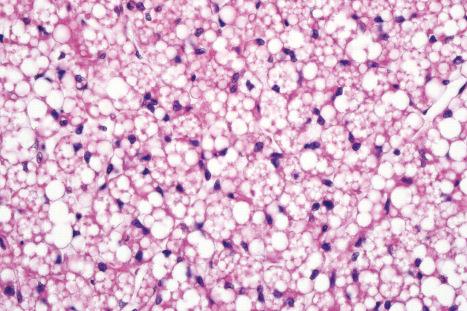 Fig. 35.17, Lipoblastoma: this field shows an admixture of adipocytes and multivacuolated lipoblasts.