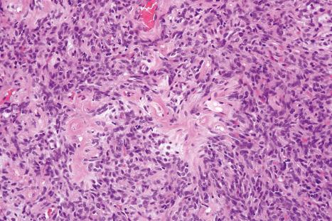 Fig. 35.172, Solitary fibrous tumor: foci of keloid formation are a characteristic feature.