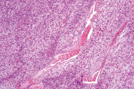 Fig. 35.173, Solitary fibrous tumor: hemangiopericytomatous vessels are often seen.