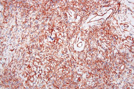 Fig. 35.174, Solitary fibrous tumor: the tumor cells show strong CD34 expression.