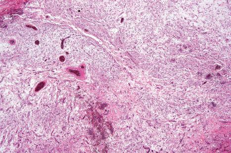 Fig. 35.175, Giant cell angiofibroma: low-power view showing prominent blood vessels and tumor cells dispersed in a myxoid stroma.