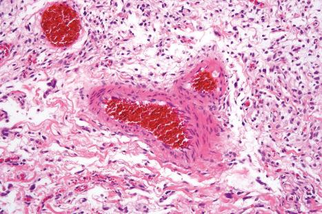 Fig. 35.176, Giant cell angiofibroma: high-power view.