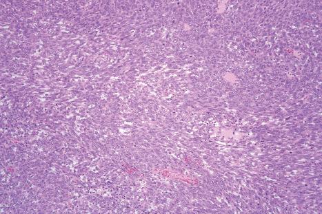 Fig. 35.178, Infantile fibrosarcoma: the tumor is densely cellular and an ill-defined herring-bone pattern is evident.