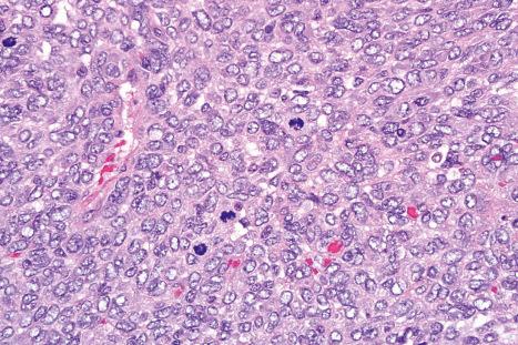 Fig. 35.180, Infantile fibrosarcoma: in this field the tumor cells are more epithelioid and show striking mitotic activity.