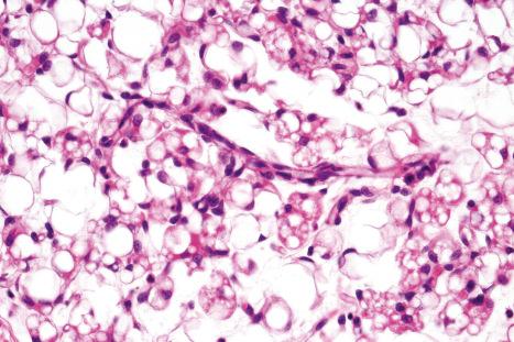 Fig. 35.18, Lipoblastoma: the adipocytes are of varying size. In the center of the field is a thin-walled, branched ‘crow's foot’ type of blood vessel.