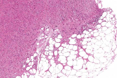 Fig. 35.181, Superficial CD34-positive fibroblastic tumor: pleomorphic spindle-shaped cells with nuclear enlargement and hyperchromatism.