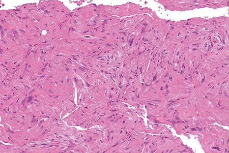 Fig. 35.183, Superficial CD34-positive fibroblastic tumor: extensive replacement of the subcutaneous tissue by a predominantly spindle cell tumor.