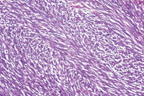 Fig. 35.184, Fibrosarcoma: marked basophilia and a herring-bone pattern of spindle cells are typical features of this lesion.