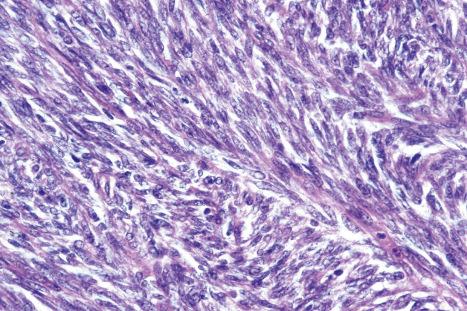 Fig. 35.185, Fibrosarcoma: the spindle cell borders are indistinct and their nuclei are elongated with thin tapered ends, unlike those in leiomyosarcoma and neurofibrosarcoma.