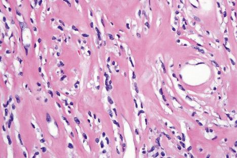 Fig. 35.187, Sclerosing epithelioid fibrosarcoma: the tumor cells characteristically show a single-file distribution.