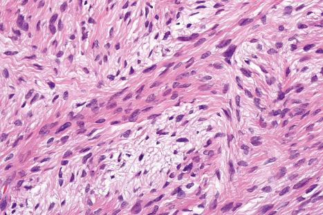 Fig. 35.189, Low-grade fibromyxoid sarcoma: high-power view.